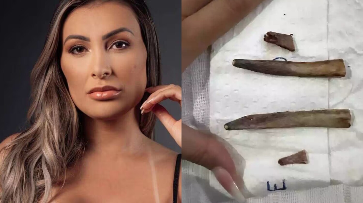 Andressa Urach mostra costelas retiradas em cirurgia: "Lindas"