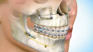 A Importância da Cirurgia Bucomaxilofacial na Odontologia Moderna