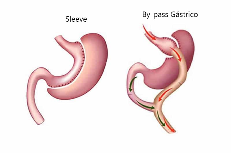 Cirurgia bariátrica, quais são seus benefícios e malefícios