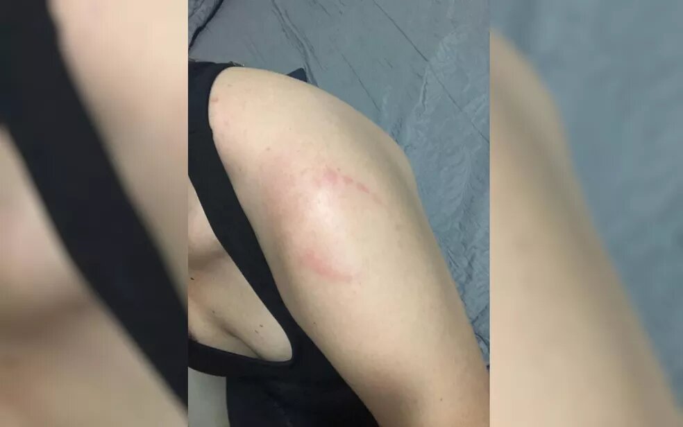 Jovem leva mordida no ombro após esbarrar em homem em academia