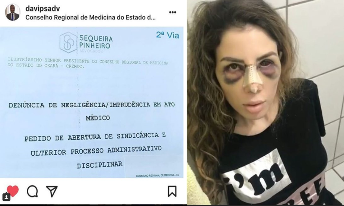 Camilla Uckers denuncia médico responsável por cirurgia plástica no Conselho Regional de Medicina